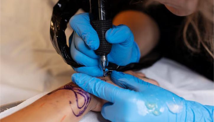 7 FAQs for tattoo removal treatment